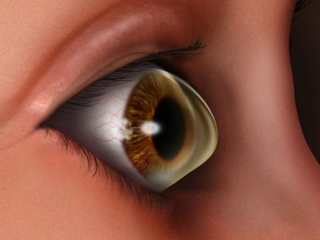 Keratoconus Management by Kiran Challa